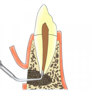 Ansa endodontica EMS Woodpecker E10