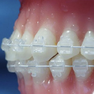 Arcuri si bracketi ortodontici estetici