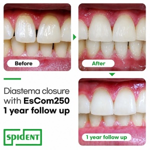 Kit EsCom 250 Spident Esbond