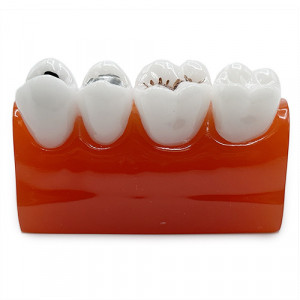 Model dentar educational tipuri de sigilari dentare YL-M10