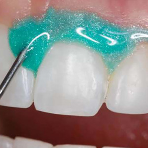 OpalDam Ultradent seringa diga lichida