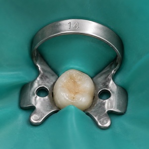Clema Diga Glossy Nr 14 Molari Partial Erupti