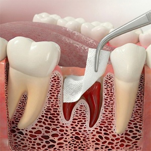 Colla Tape Pansament Colagen use