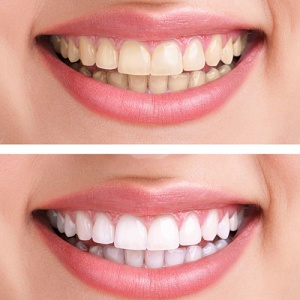 Kit De Albire Dentara LWS Compatibil Laser Doctor Smile
