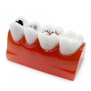 Model educational sigilari di carii dentare YL-M10