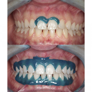 i-DAM diga lichida seringa 3.5g blue