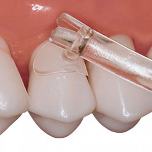Kit Matrici Cervicale Transparente 275BUC