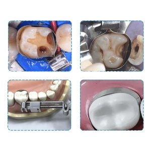 Matrici Dentare Conturate Modelabile 0.04mm 20buc