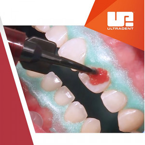 Opalescence Boost 40 seringa albire dentara
