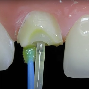 Pivoti fibra de sticla endodontie Matchpost RTD 10buc