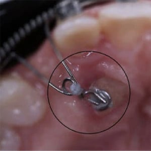 Buton de tractiune ortodontica colabil 10 bucati