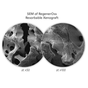 Os Porcin RegenerOss Resorbable Xenograf Seringa