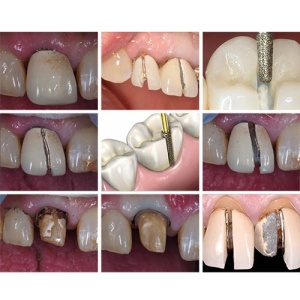 Ablatie Dentara Eficienta 7 freze