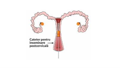 Inseminarea artificială postcervicală: rapidă, eficientă și profitabilă