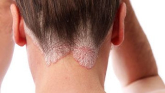 PSORIAZISUL-ÎMBUNĂTĂȚIREA CALITĂȚII VIEȚII PACIENȚILOR DIAGNOSTICAȚI