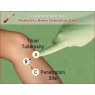 Bone Injection Gun Penn Care