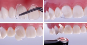 Cape Celuloid CoForm Set Directa Dental - Img 2