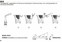Ansa Chirurgicala UL5 Mectron Woodpecker