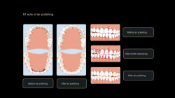 Aparat profilaxie AP-H Plus (supragingival si subgingival) Woodpecker
