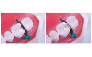 FenderMate Right Regular 18 buc Directa Dental - Img 2