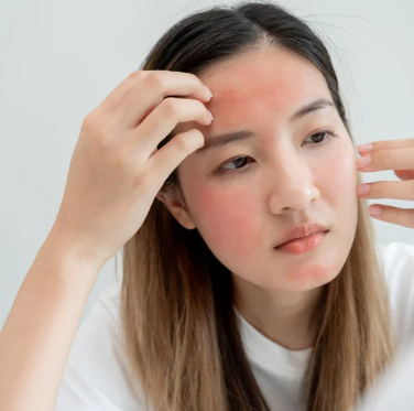 Dermatita seboreică pe scalp – Ce trebuie să știi