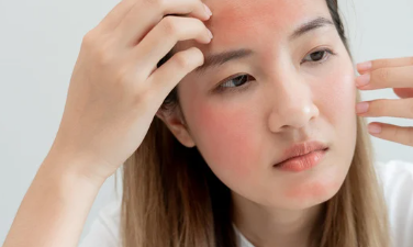 Dermatita seboreică pe scalp – Ce trebuie să știi