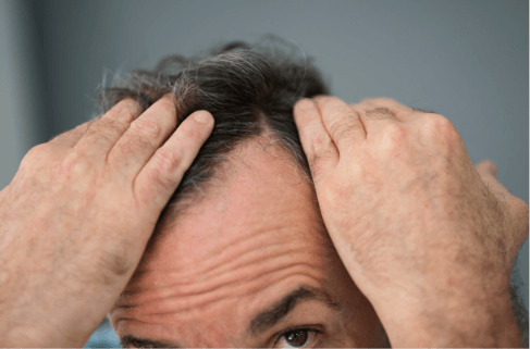 barbat-cu-alopecie