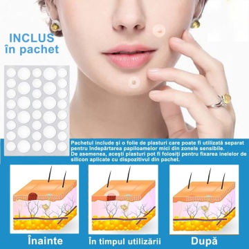 Kit Indepartare Papiloame QuTek- Dispozitiv Ligaturare 2-8mm, Usor de Folosit, Rezultate Rapide, 40 Benzi Cauciuc, 2 Capete Interschimbabile, 10 Servetele Alcool, 36 plasturi transparenti, Alb/Albastru - Img 5