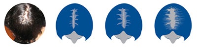 progresie alopecie ereditara femeie