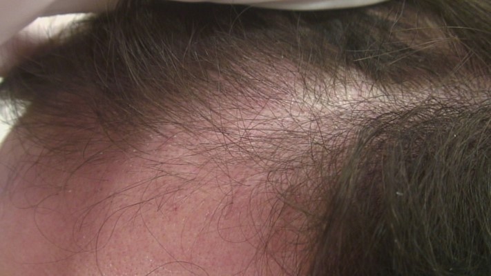 progresie alopecie ereditara barbat
