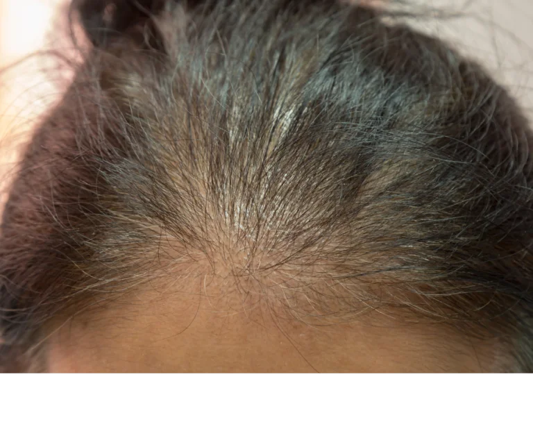 alopecia difuza
