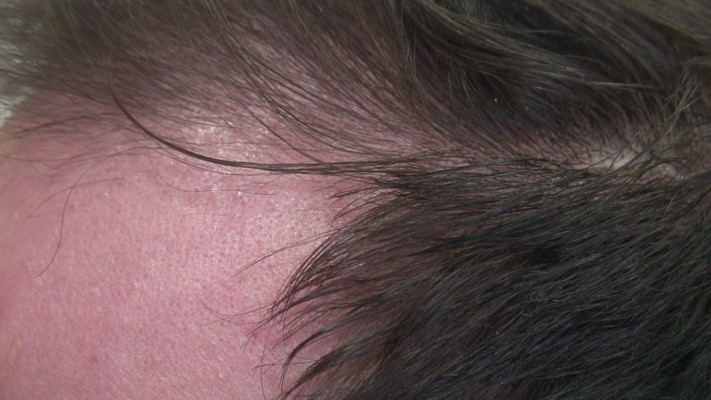 progresie alopecie ereditara barbat