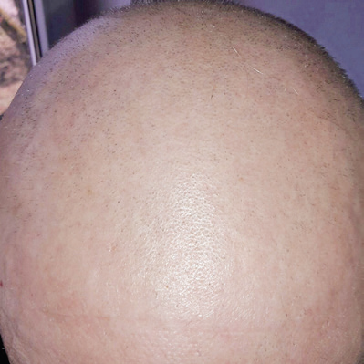 scalp fara par