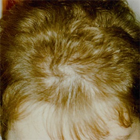 scalp cu pete de chelie