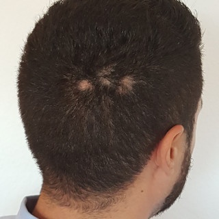 scalp cu pete de chelie