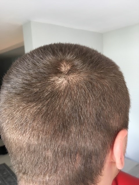 scalp cu pete de chelie