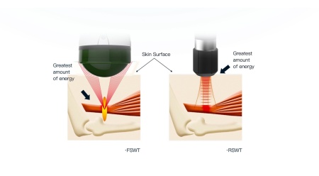 Dispozitiv de terapie cu unde de șoc electromagnetice focalizate AresPro EMFOCUS PRO unde de șoc focalizate - Img 6