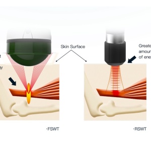 Dispozitiv de terapie cu unde de șoc electromagnetice focalizate AresPro EMFOCUS PRO unde de șoc focalizate - Img 6