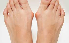 Ce marcă de încălțăminte pentru hallux valgus?