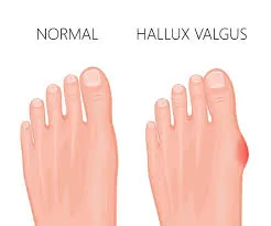 hallux valgus picior